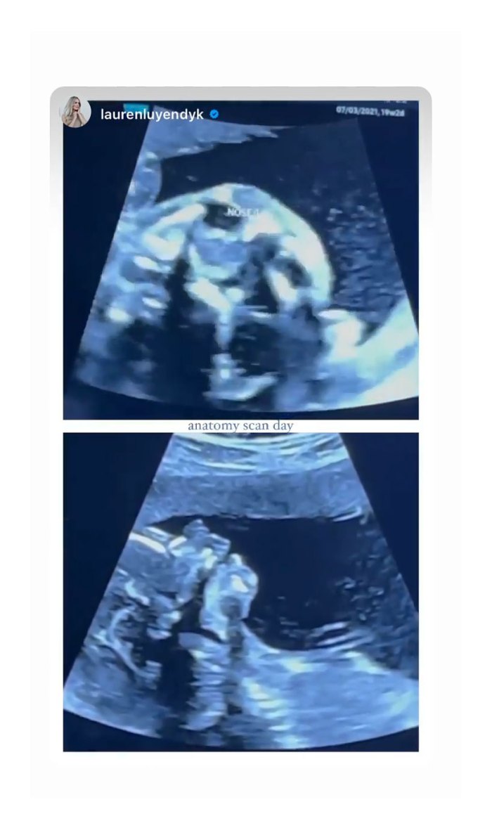 Arie Luyendyk Jr Isn't Allowed in Pregnant Lauren Burnham Ultrasound Appointment Amid Pandemic