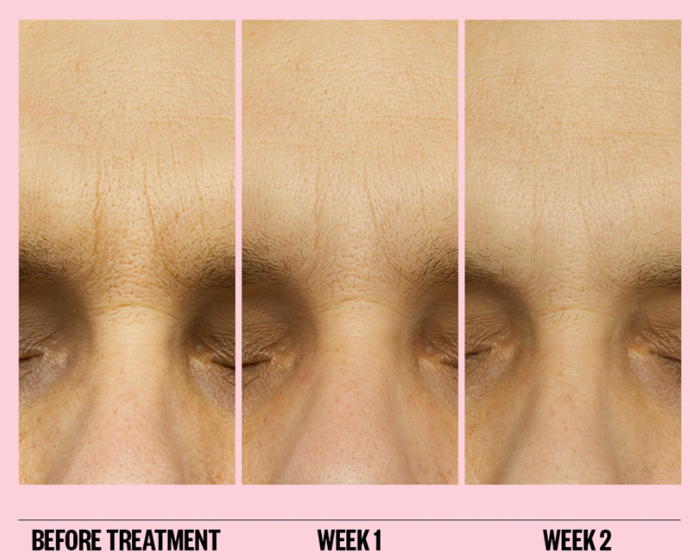 peace-out-microneedling-patches-wrinkle-before-after