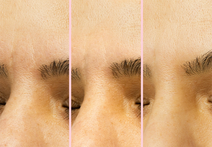 peace-out-microneedling-patches-wrinkle-before-after-2