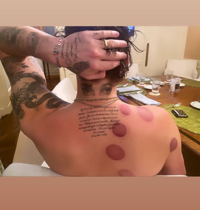 Everything We Know About Brooklyn Beckham’s Body Bruising Treatment