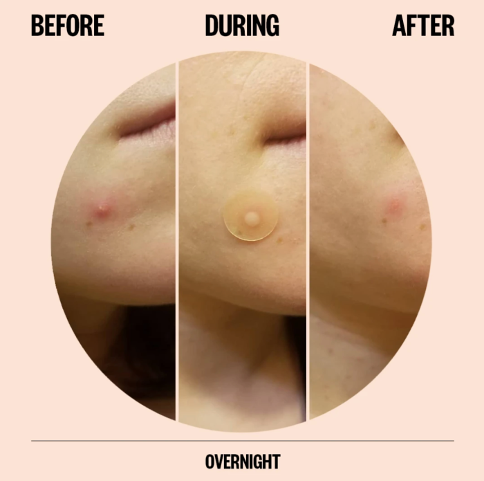 Peace Out Acne Dots