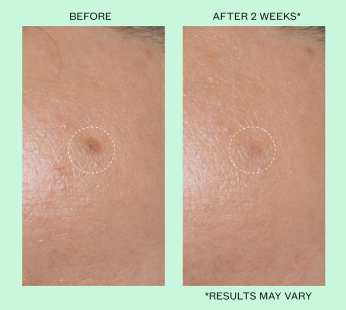 Peace Out Dark Spots Dissolving Microneedling Brightening Dots