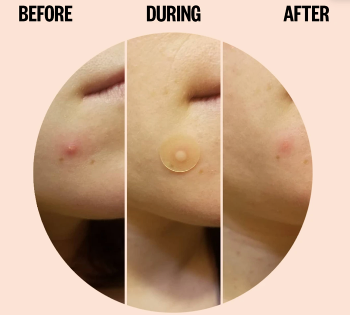 Peace Out Acne Dots