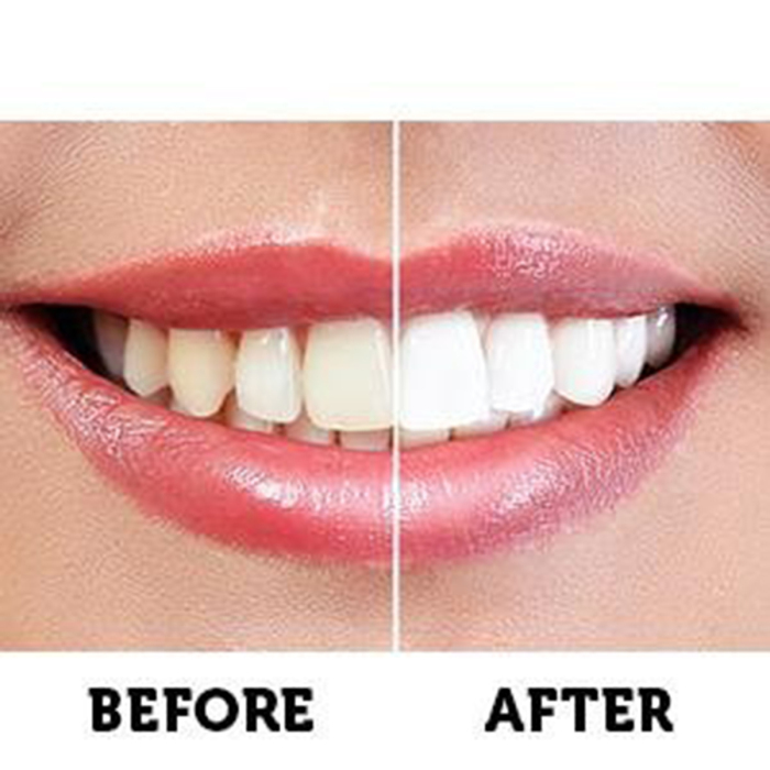 white-teeth