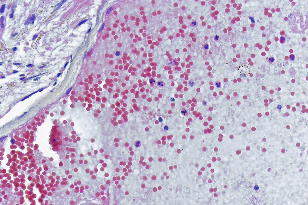Under a microscope magnification of 500X, this image depicted a section of skin tissue, Monkeypox virus