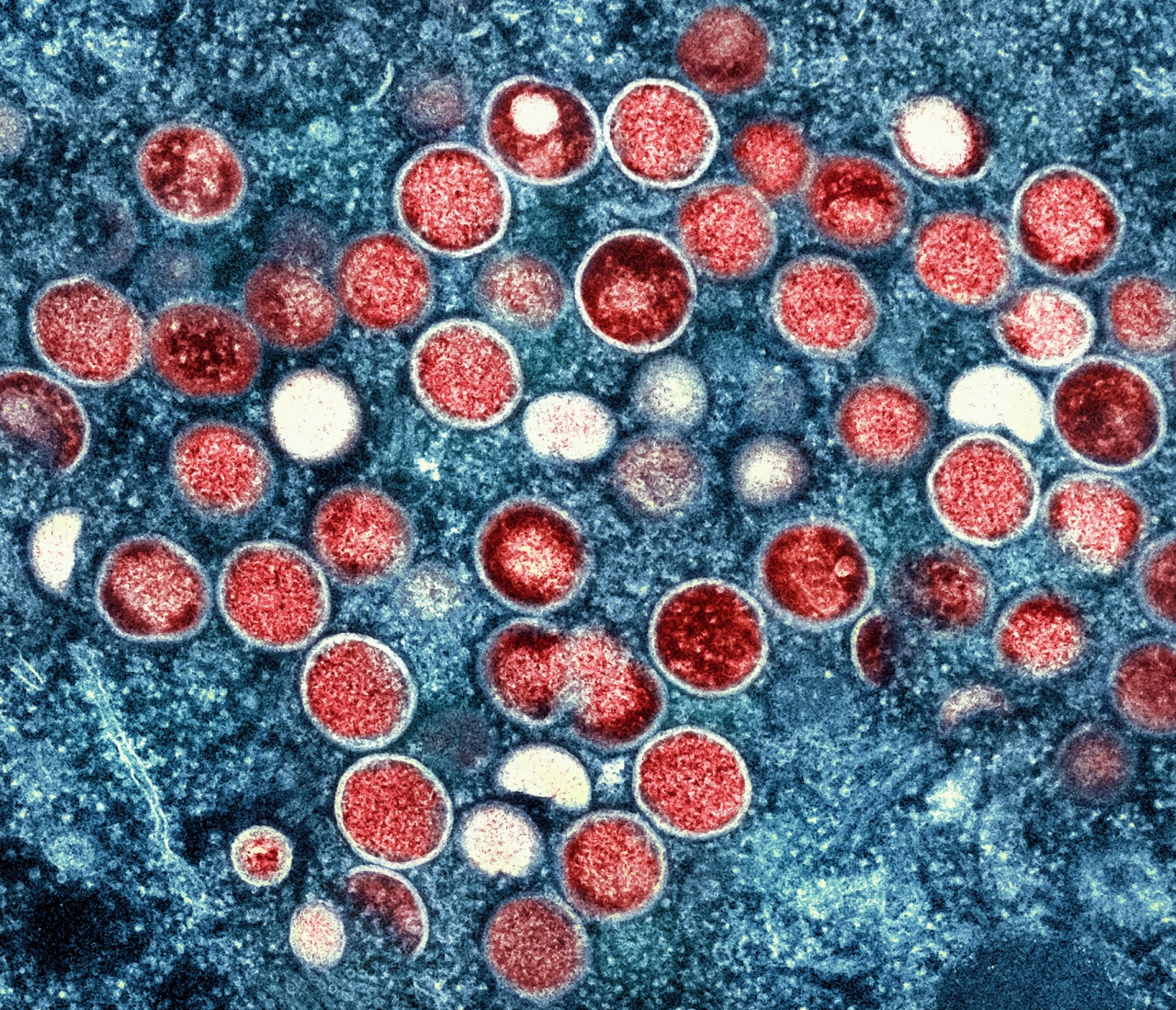UK: 'First signs' monkeypox outbreak may reach peak | WGN 720 Radio